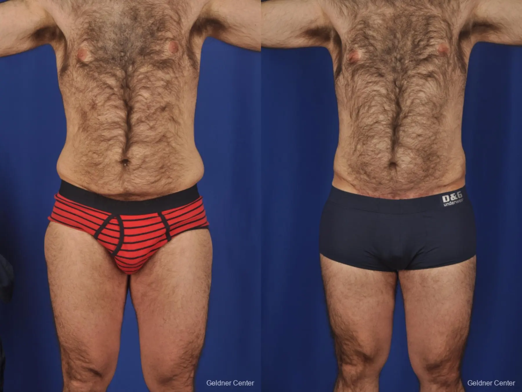 Abdominoplasty-for-men: Patient 1 - Before and After  