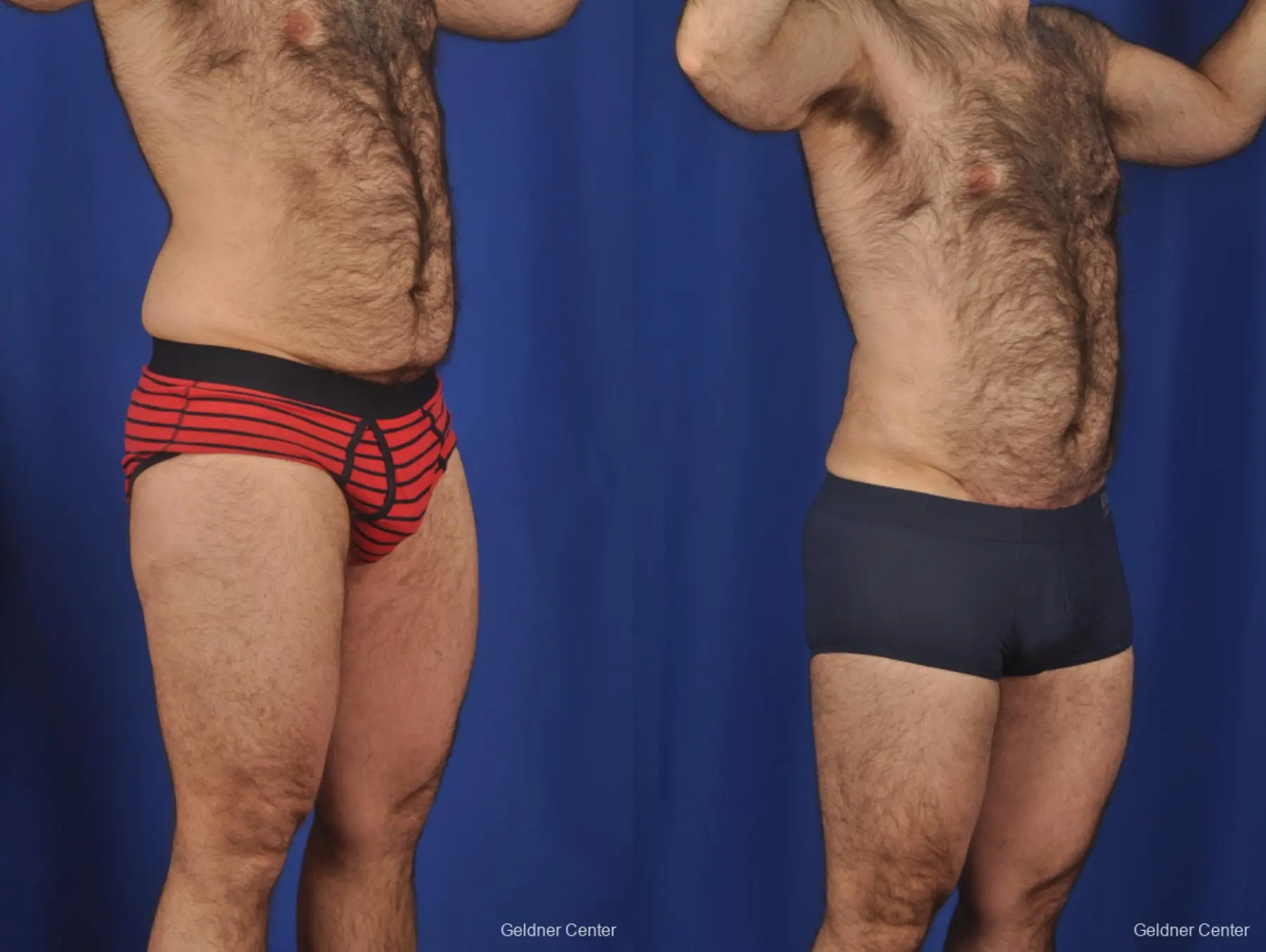 Abdominoplasty For Men: Patient 1 - Before and After 2