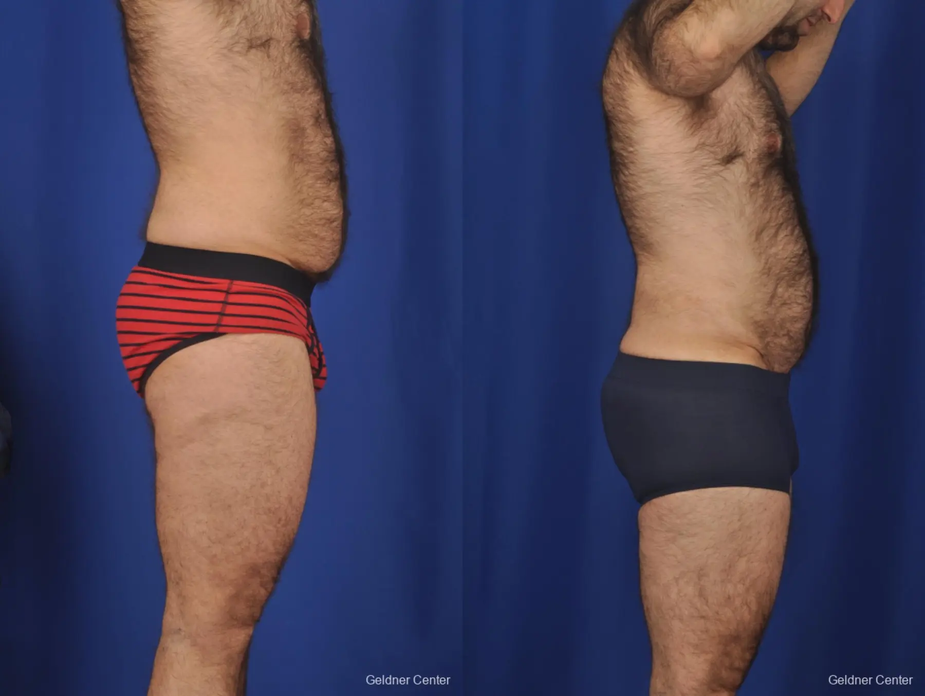Abdominoplasty For Men: Patient 1 - Before and After 3