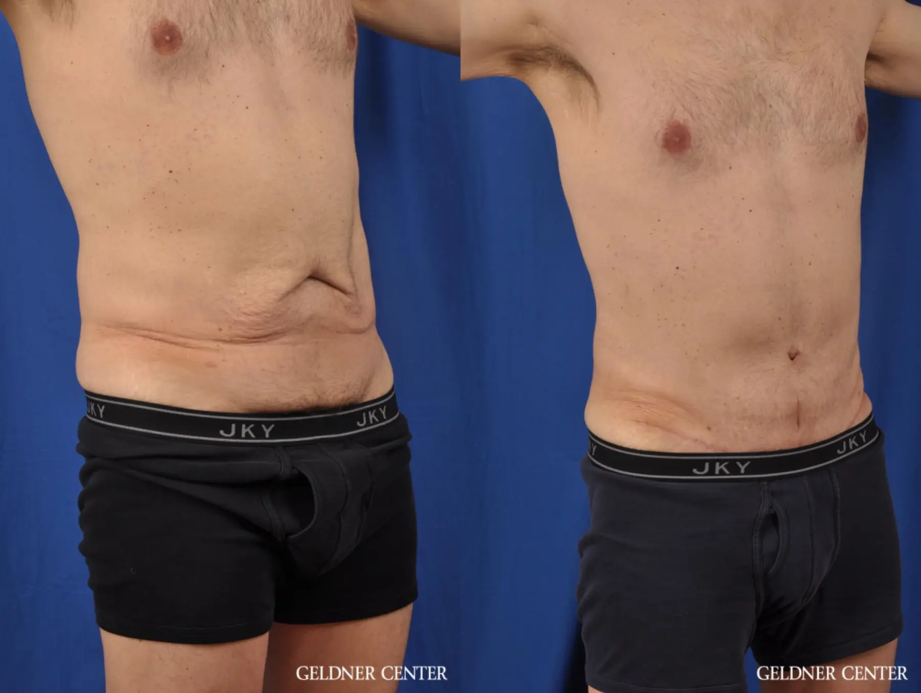 Abdominoplasty For Men: Patient 2 - Before and After 2