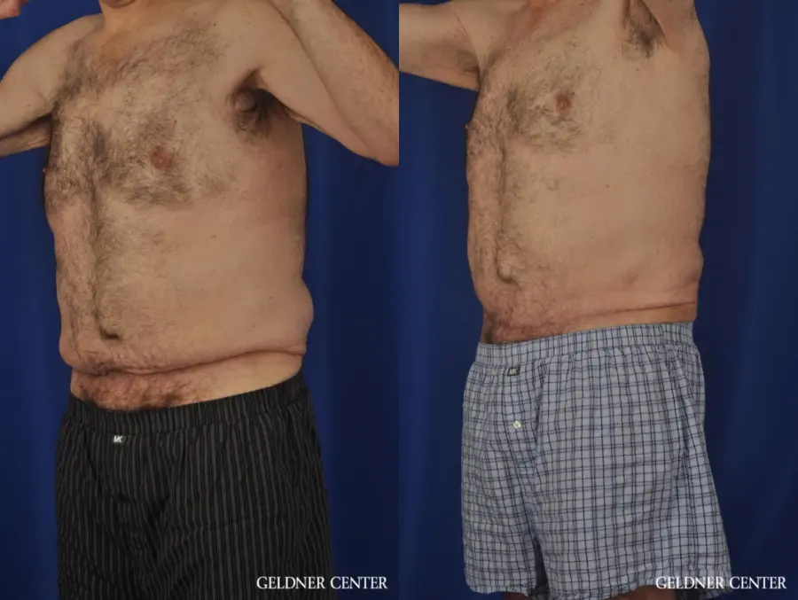 Abdominoplasty For Men: Patient 3 - Before and After 5