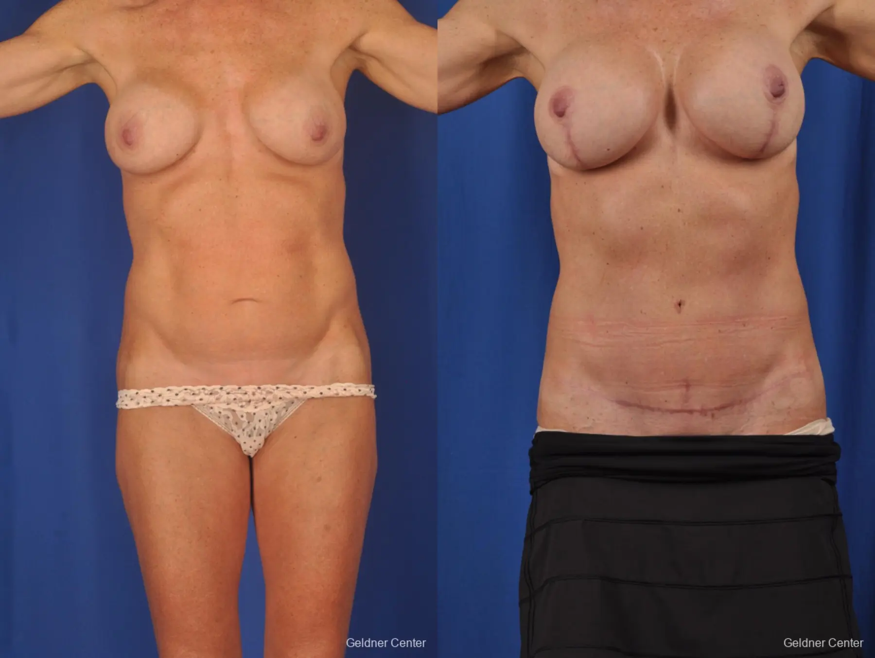Abdominoplasty: Patient 2 - Before and After  