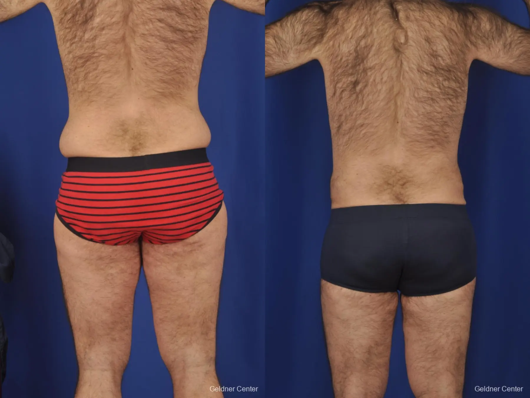 Abdominoplasty For Men: Patient 1 - Before and After 4