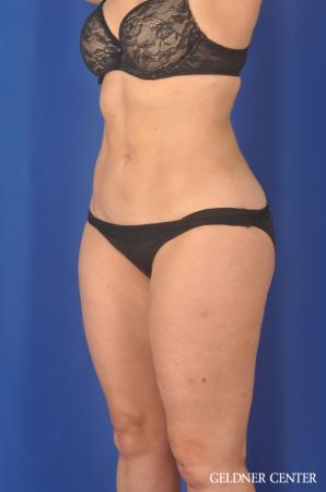 Liposuction: Patient 32 - After 5