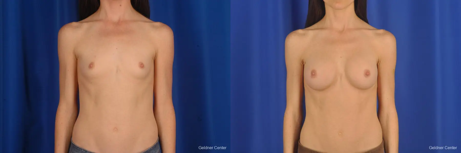 Breast Augmentation Hinsdale, Chicago 2311 - Before and After