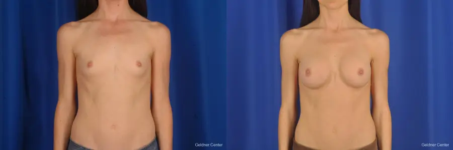 Breast Augmentation Hinsdale, Chicago 2311 - Before and After 1