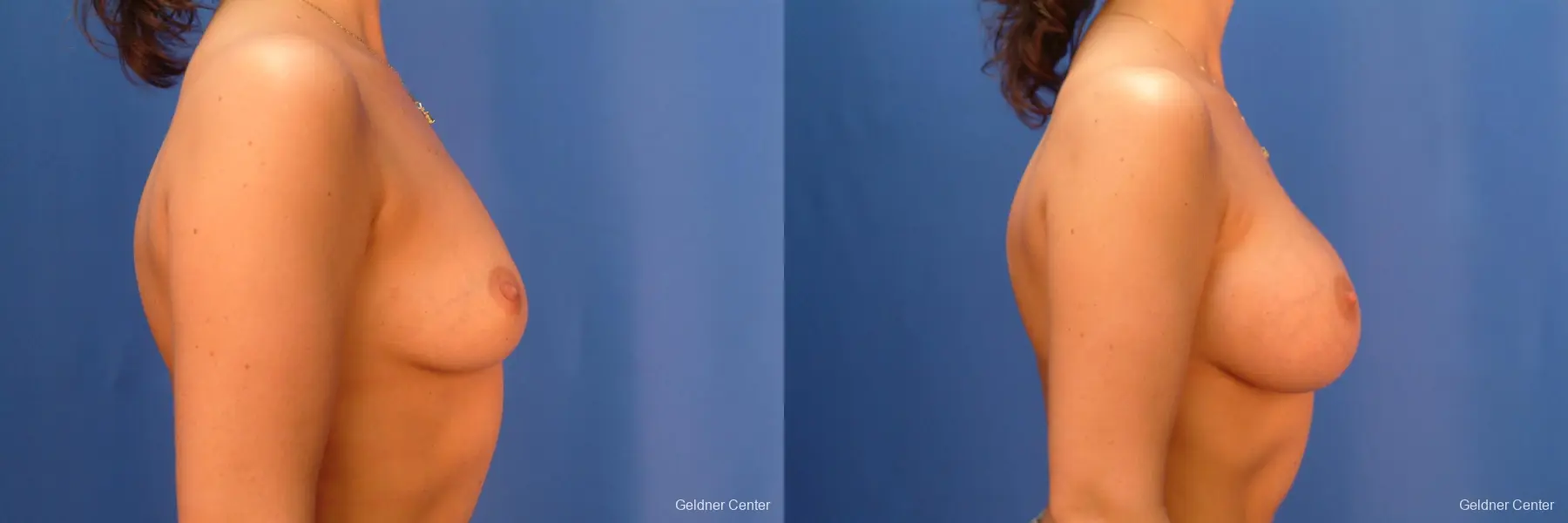 Chicago Breast Augmentation 2432 - Before and After 2