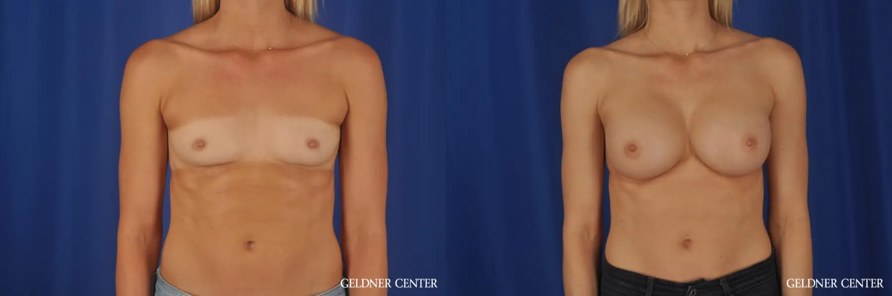 Breast Augmentation Hinsdale, Chicago 8619 - Before and After