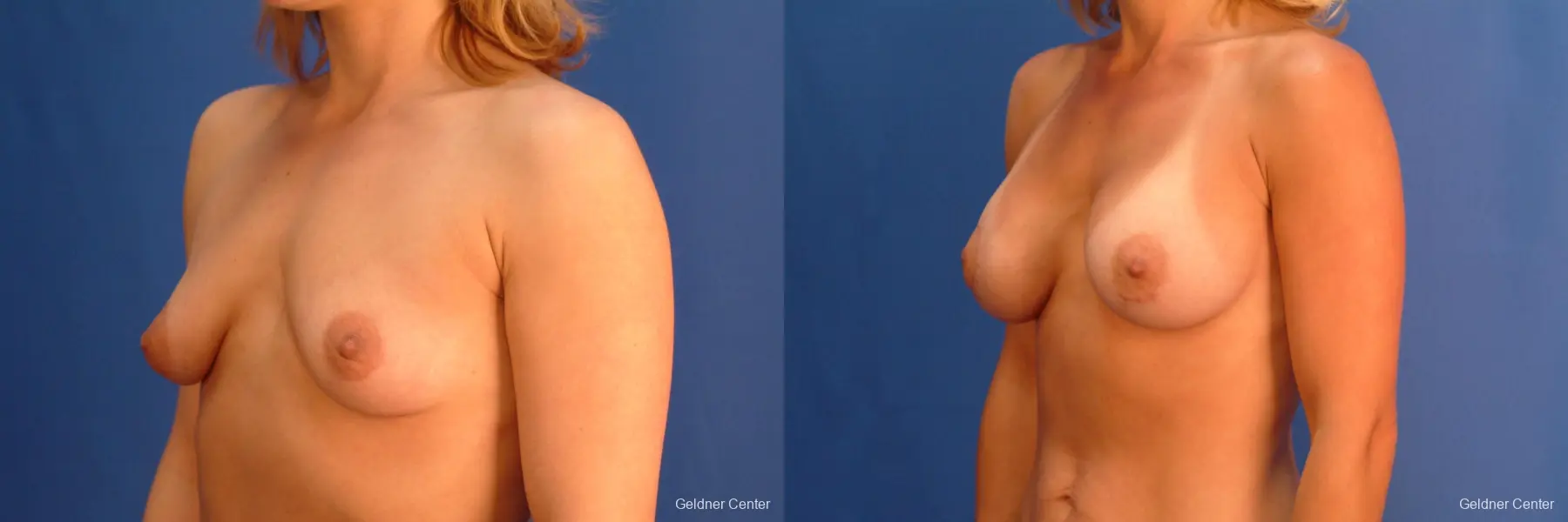 Breast Augmentation Lake Shore Dr, Chicago 2637 - Before and After 4