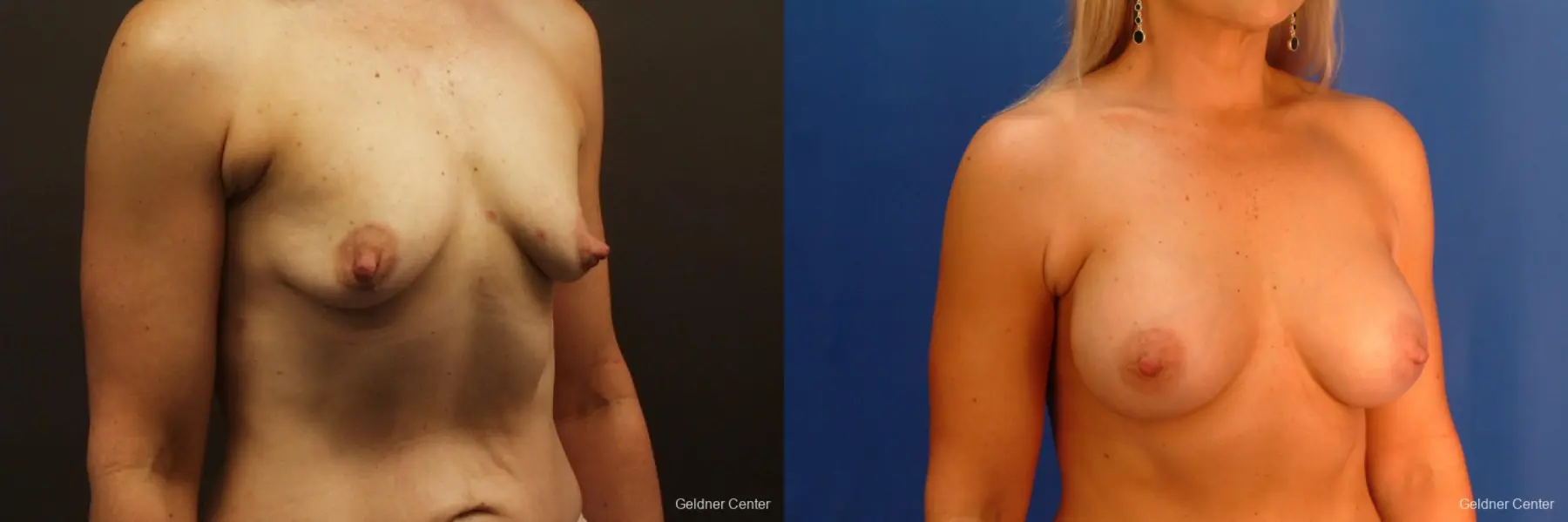 Breast Augmentation Hinsdale, Chicago 2632 - Before and After 3