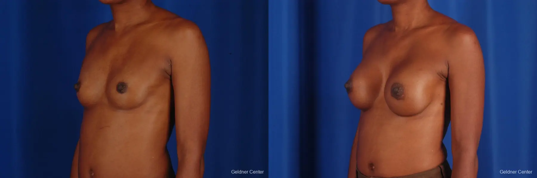 Chicago Breast Augmentation 2293 - Before and After 5