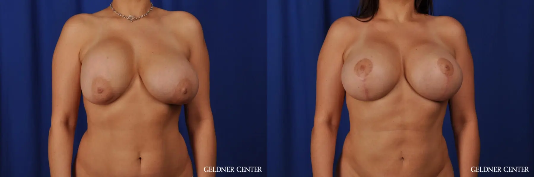 Chicago Breast Augmentation 5541 - Before and After