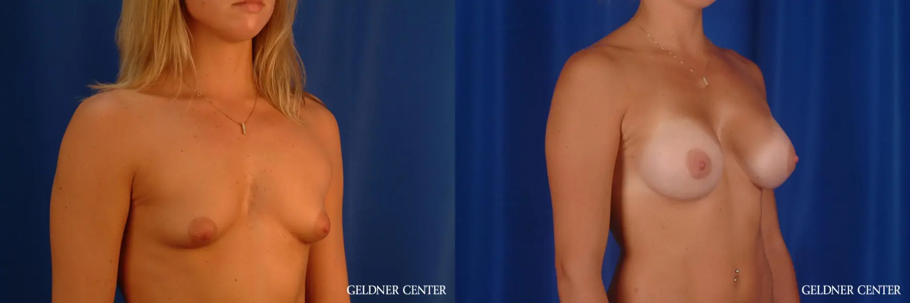 Breast Augmentation: Patient 173 - Before and After 2