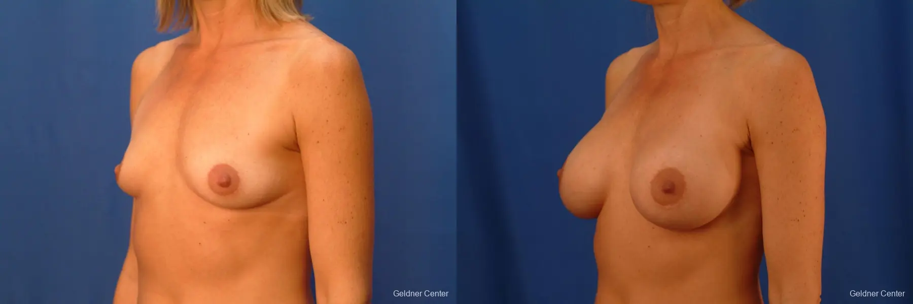 Breast Augmentation Lake Shore Dr, Chicago 2446 - Before and After 3