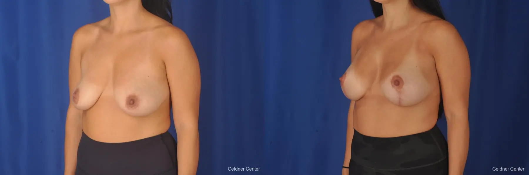 Breast Augmentation: Patient 79 - Before and After 5