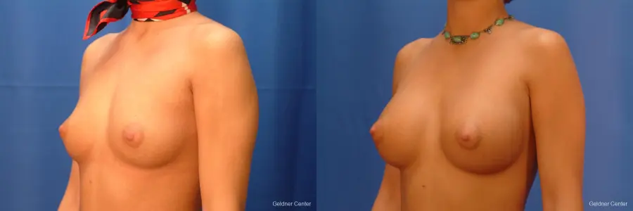 Breast Augmentation Hinsdale, Chicago 2438 - Before and After 4