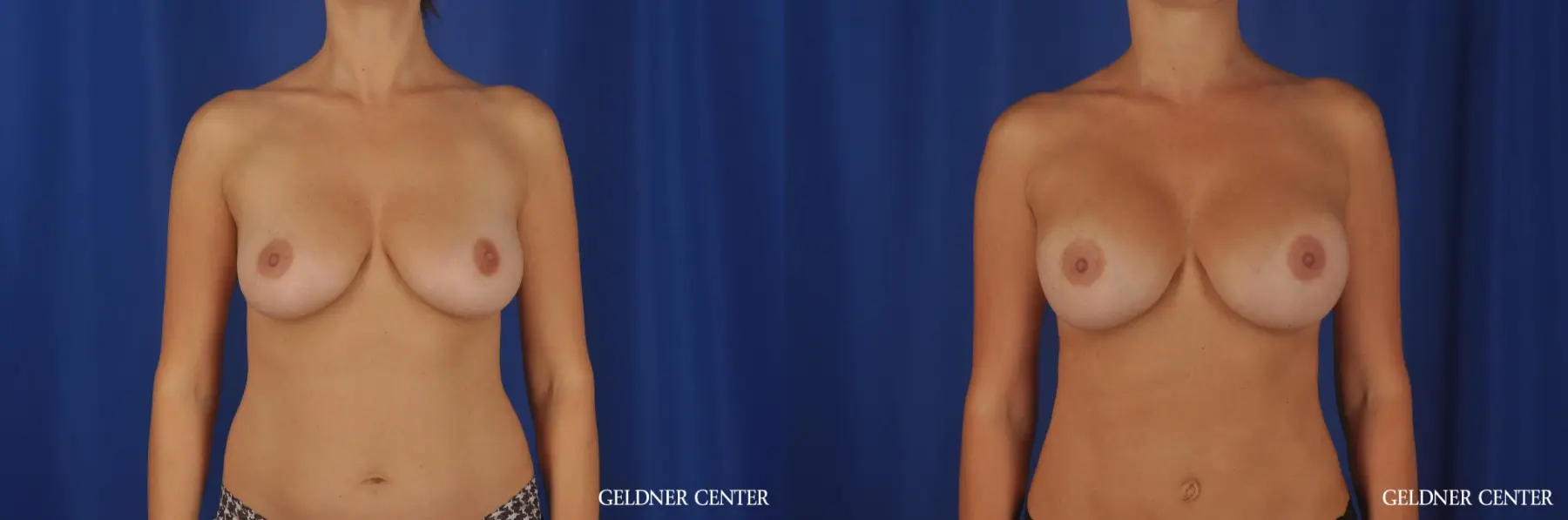 Chicago Breast Augmentation 8746 - Before and After