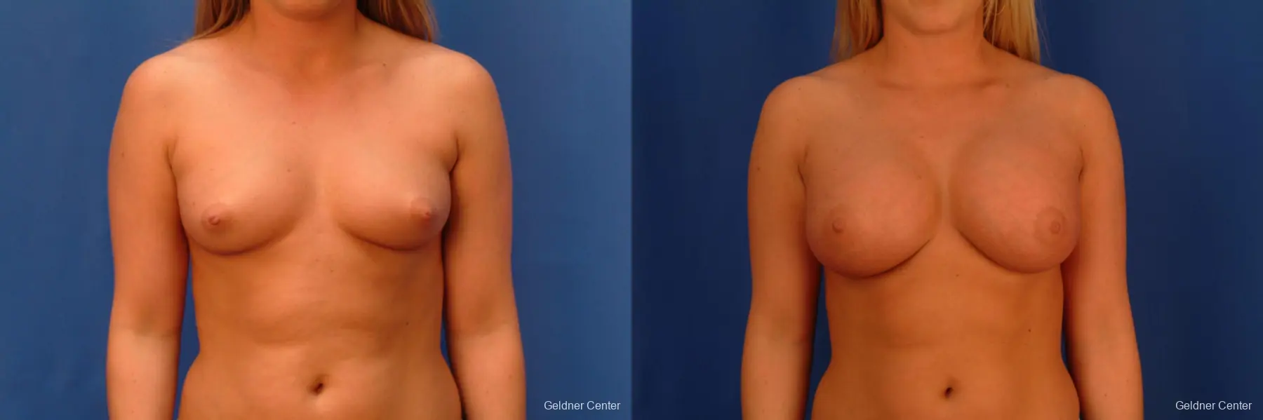 Chicago Breast Augmentation 2443 - Before and After