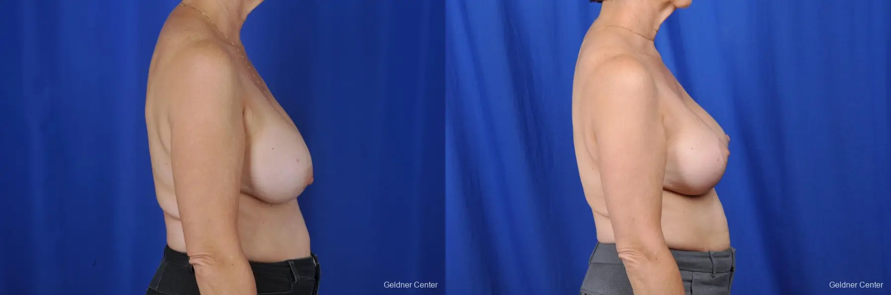 Breast Augmentation Lake Shore Dr, Chicago 2057 - Before and After 2