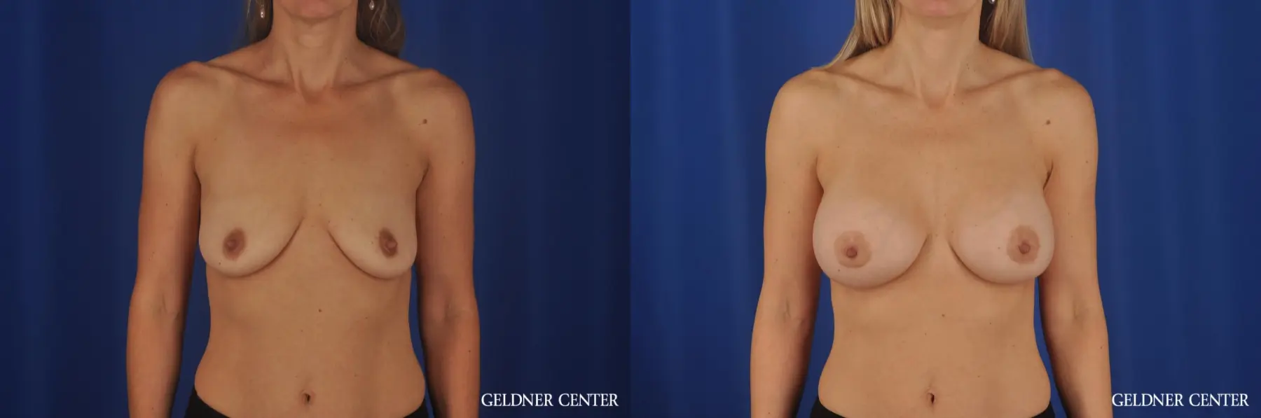 Breast Augmentation Lake Shore Dr, Chicago 8748 - Before and After