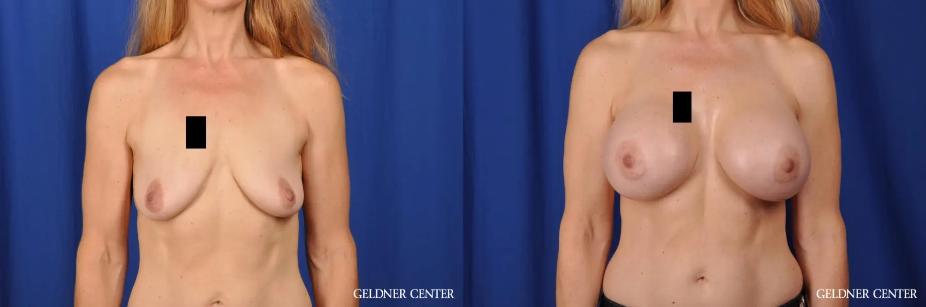 Chicago Breast Augmentation 5467 - Before and After