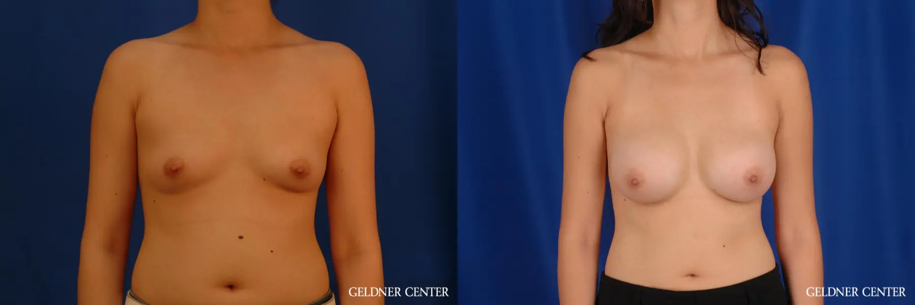Breast Augmentation: Patient 178 - Before and After 1