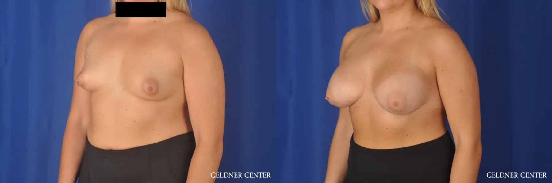 Breast Augmentation: Patient 180 - Before and After 4