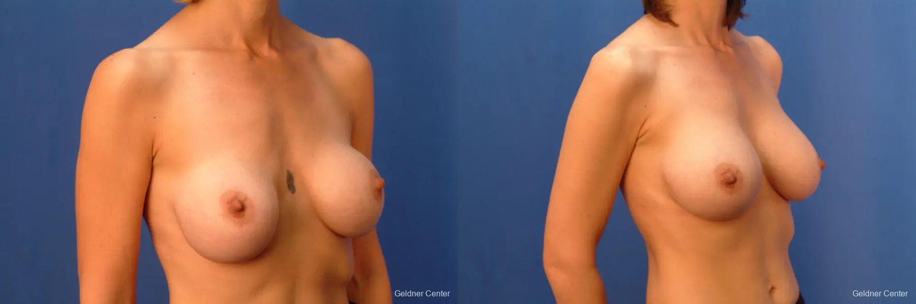 Chicago Breast Augmentation 2414 - Before and After 2