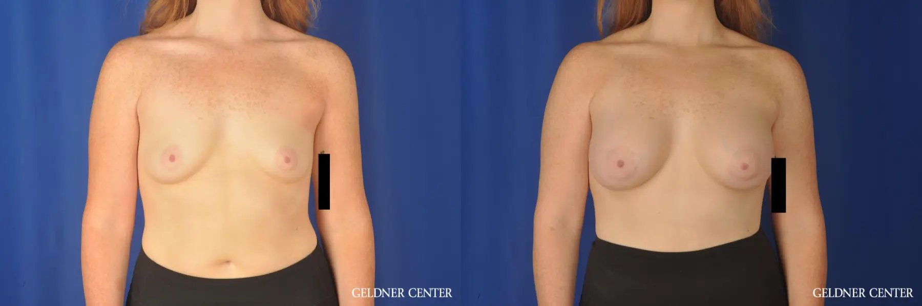 Subpectoral Biplanar Position Implants Before and After - Before and After