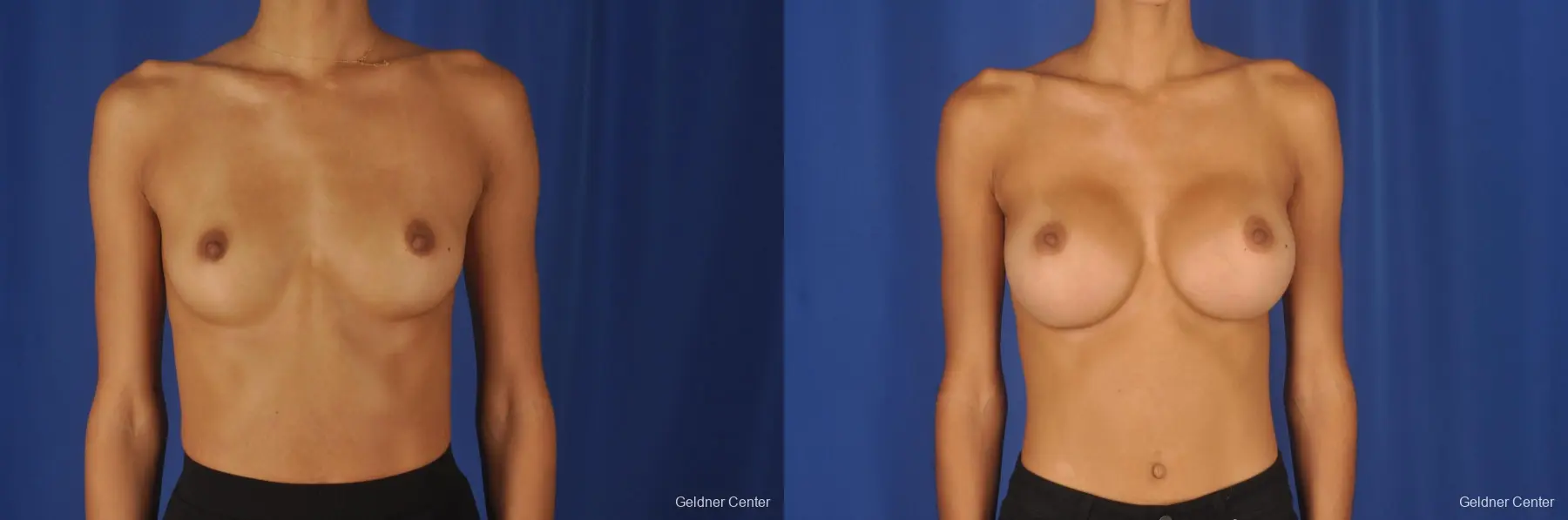Breast Augmentation: Patient 85 - Before and After 1