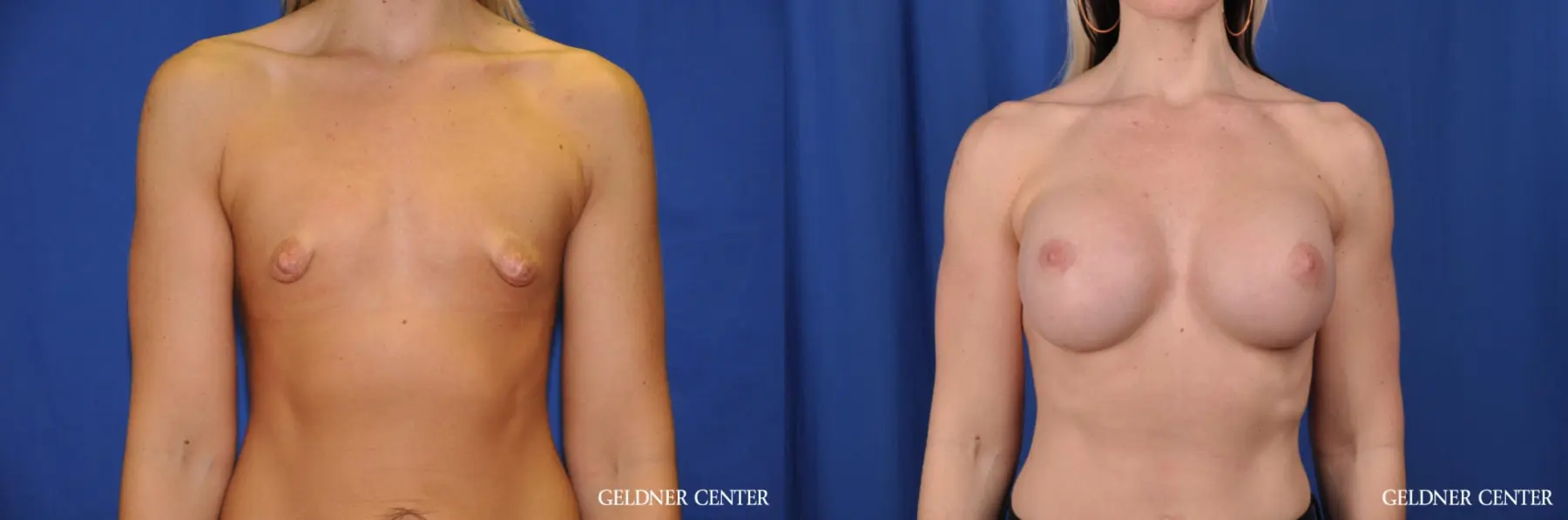 Breast Augmentation: Patient 183 - Before and After 1
