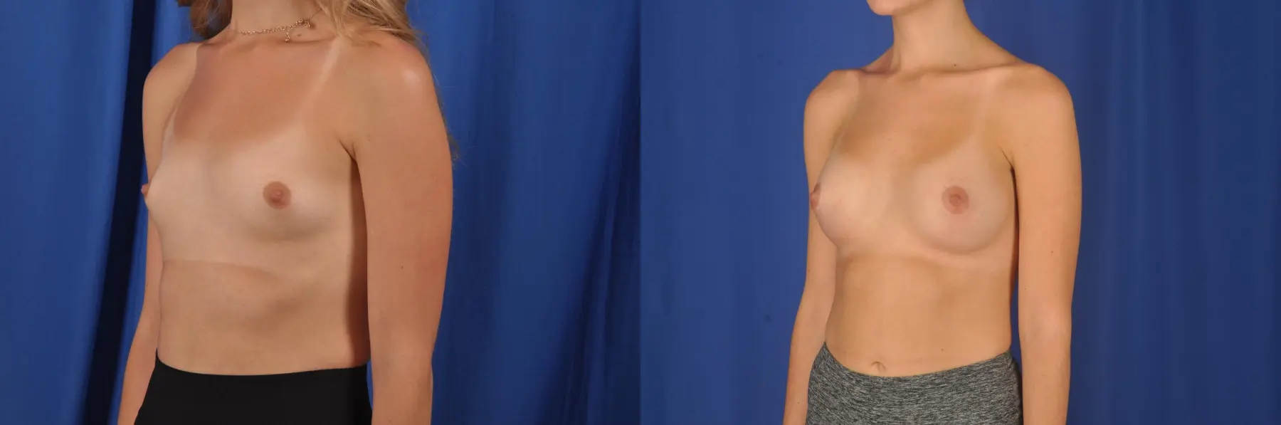 Breast Augmentation: Patient 83 - Before and After 4