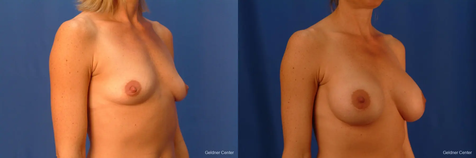 Breast Augmentation Lake Shore Dr, Chicago 2446 - Before and After 2