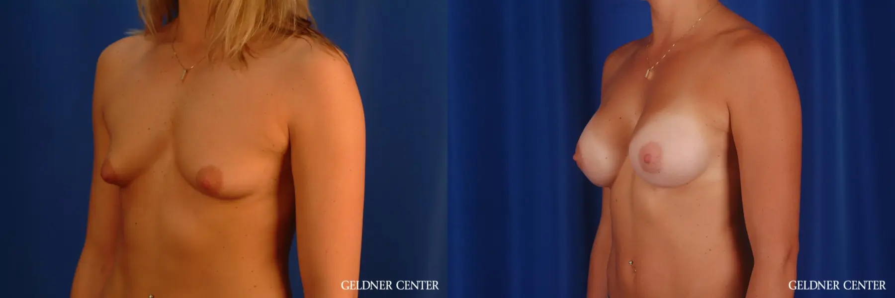 Breast Augmentation: Patient 173 - Before and After 4