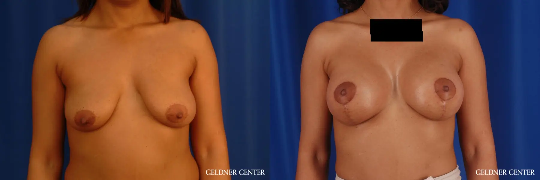Breast Augmentation: Patient 184 - Before and After 1