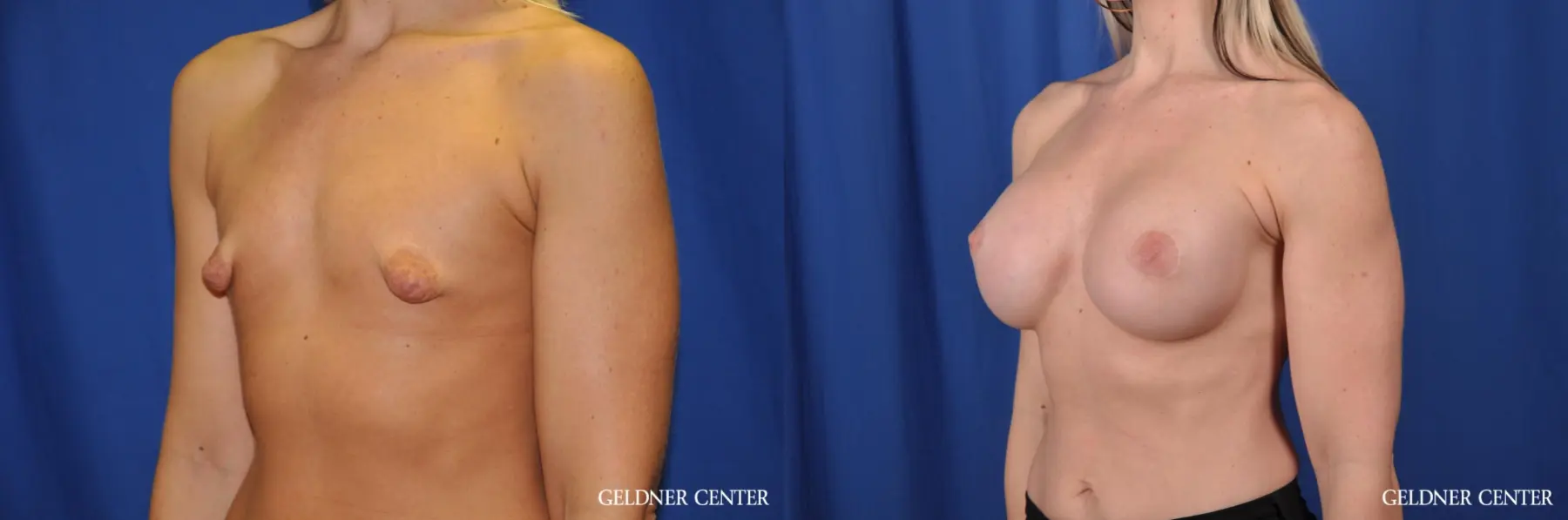 Breast Augmentation: Patient 183 - Before and After 4