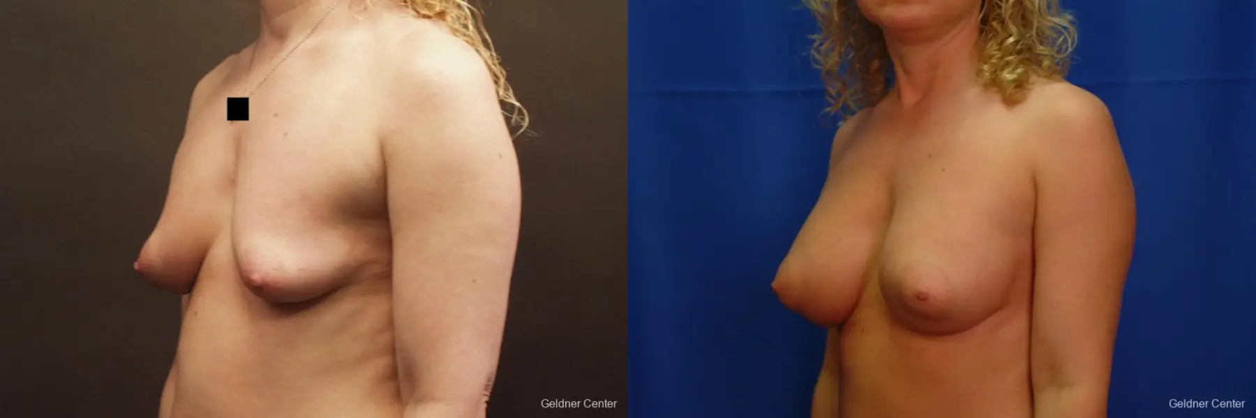 Breast Augmentation Lake Shore Dr, Chicago 2436 - Before and After 5