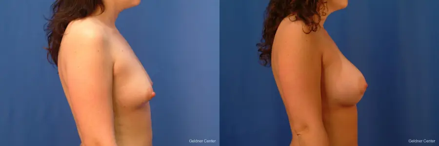 Chicago Breast Augmentation 2517 - Before and After 2
