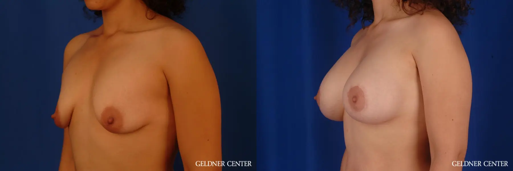 Breast Augmentation: Patient 161 - Before and After 4