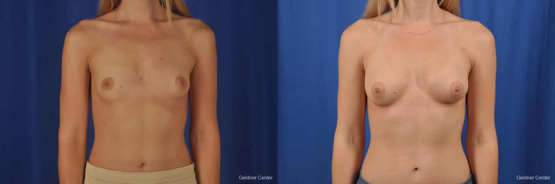 Breast Augmentation: Patient 150 - Before and After 1