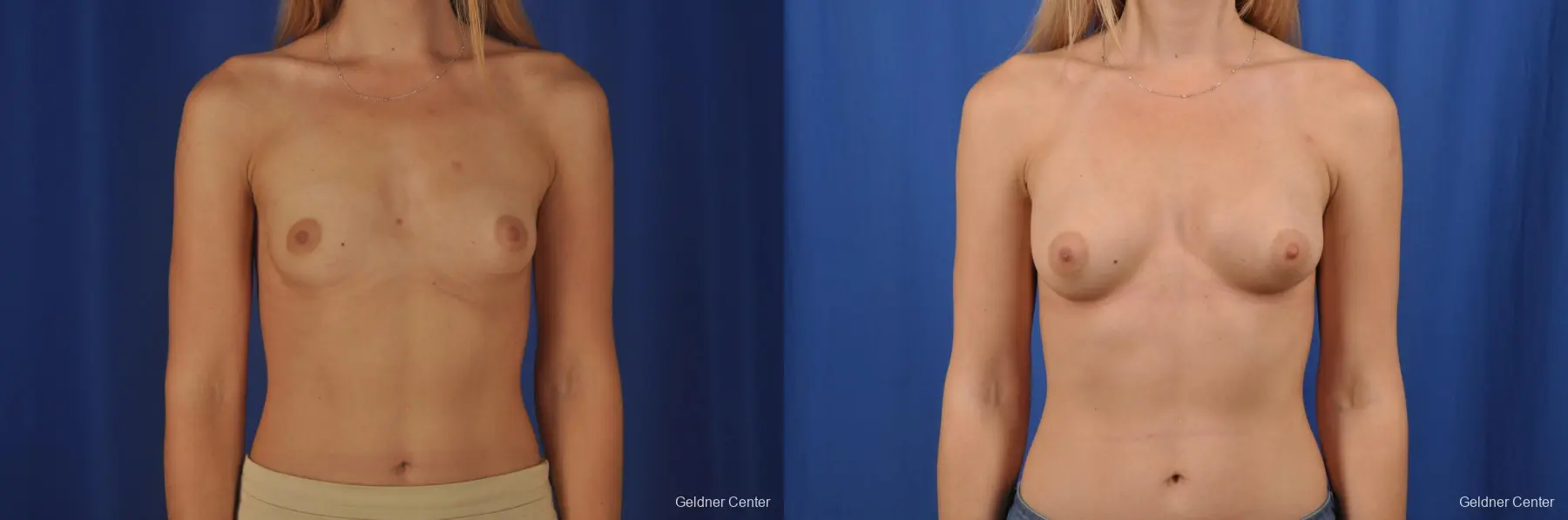 Transaxillary Subpectoral Endoscopic Breast Augmentation - Before and After