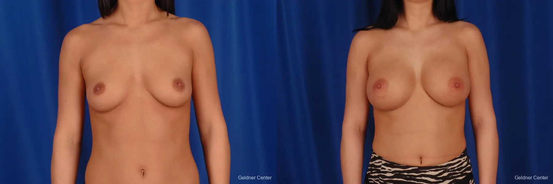 Breast Augmentation Lake Shore Dr, Chicago 2402 - Before and After 1
