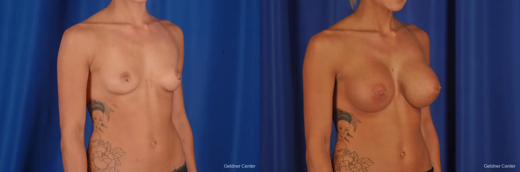 Chicago Breast Augmentation 2328 - Before and After 3
