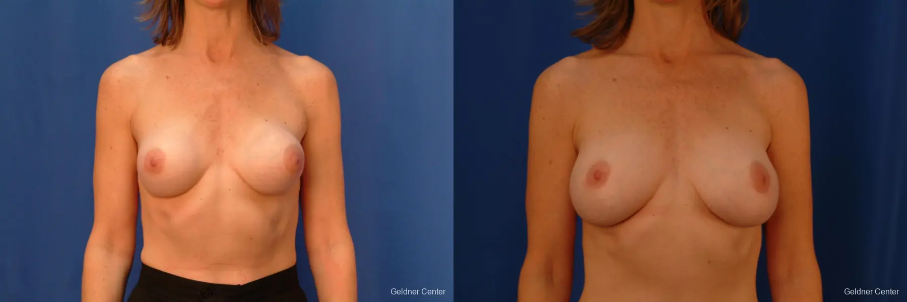 Chicago Breast Augmentation 2444 - Before and After 1