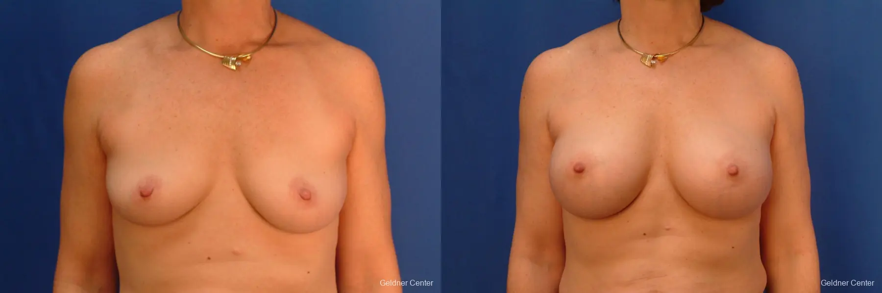 Breast Augmentation Hinsdale, Chicago 2541 - Before and After 1