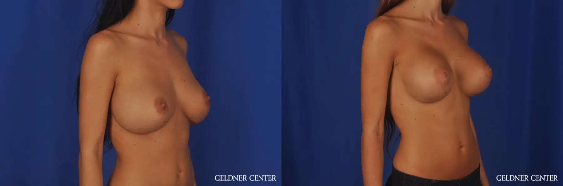 Breast Augmentation: Patient 163 - Before and After 2