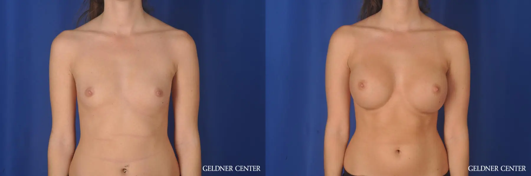 Breast Augmentation Streeterville, Chicago 11853 - Before and After