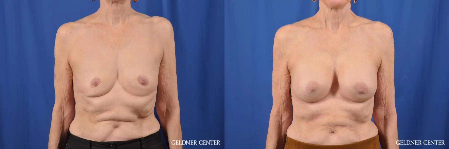 Breast Augmentation: Patient 139 - Before and After 1