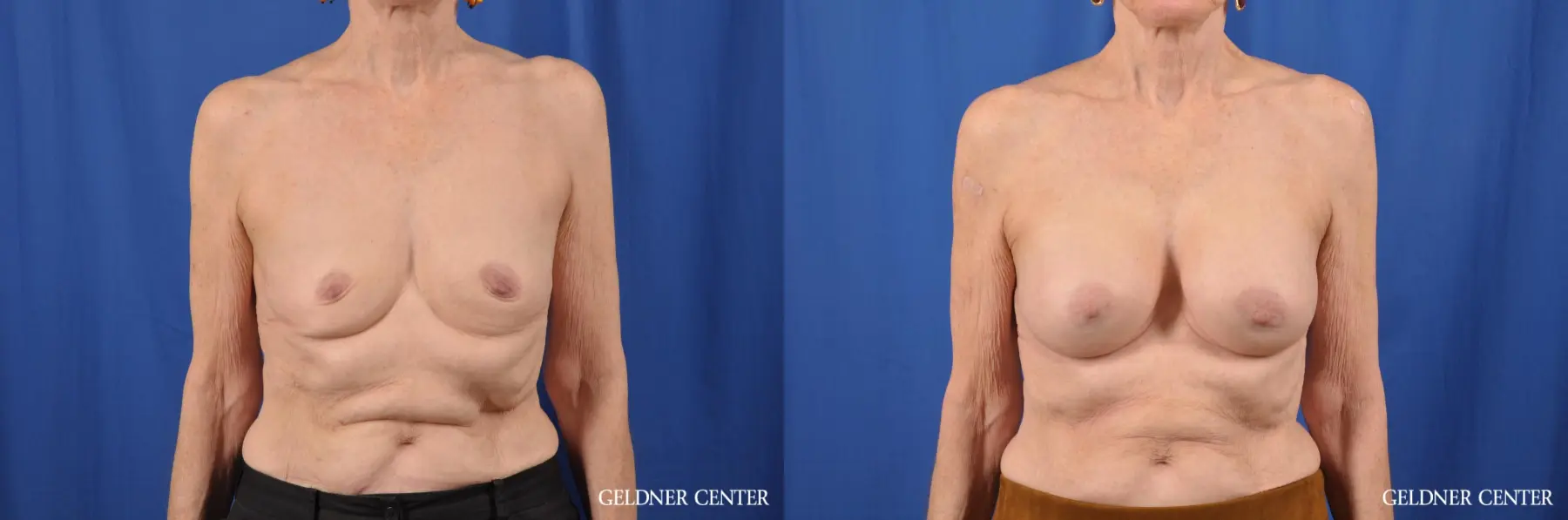 Biplanar Subpectoral 250cc - Before and After