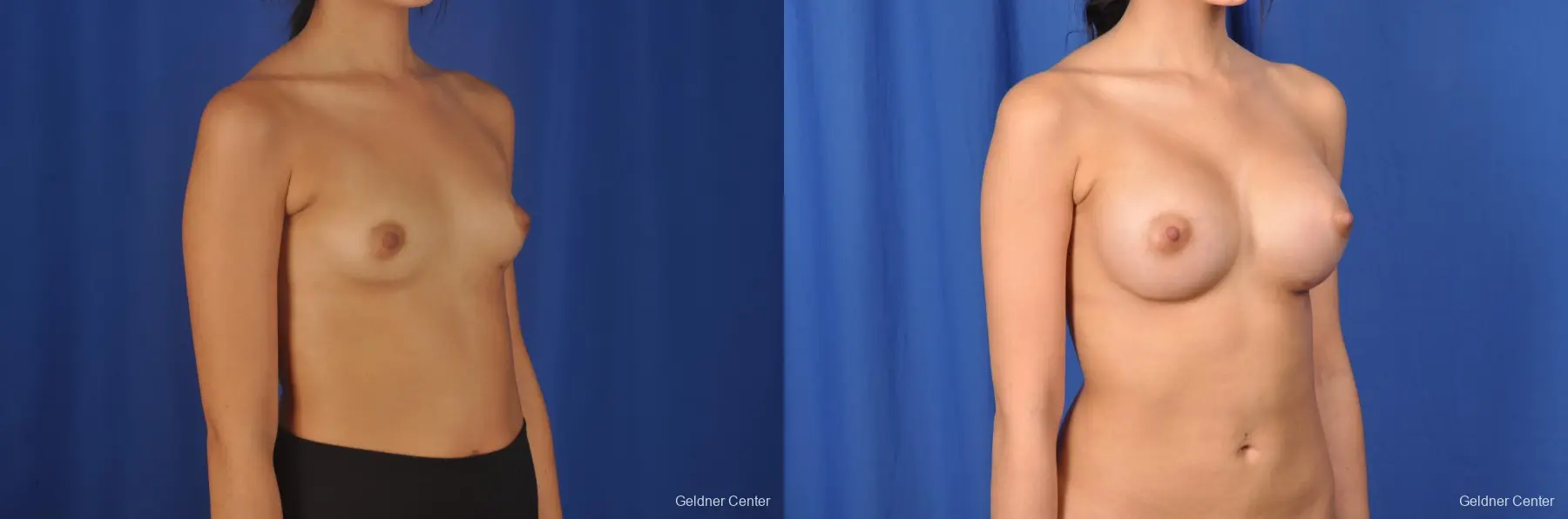 Breast Augmentation Streeterville, Chicago 8616 - Before and After 3